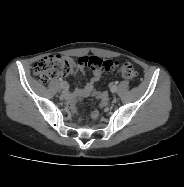 File:Autosomal dominant polycystic kidney disease - early onset (Radiopaedia 40734-43387 A 68).jpg