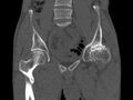Avascular necrosis of the left hip (Radiopaedia 75068-86125 Coronal bone window 21).jpg