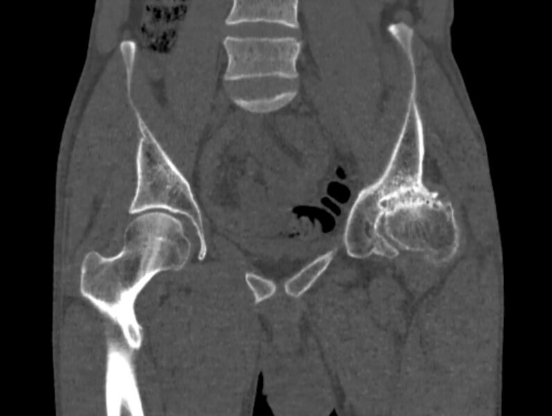 File:Avascular necrosis of the left hip (Radiopaedia 75068-86125 Coronal bone window 21).jpg