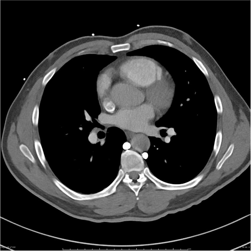 Azygos venous system anatomy (CT pulmonary angiography) (Radiopaedia 25928-26077 Axial C+ CTPA 48).jpg