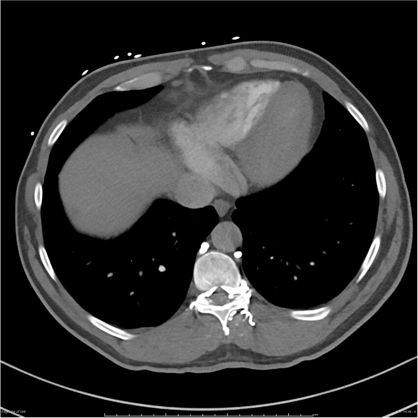 Azygos venous system anatomy (CT pulmonary angiography) (Radiopaedia 25928-26077 Axial C+ CTPA 70).jpg