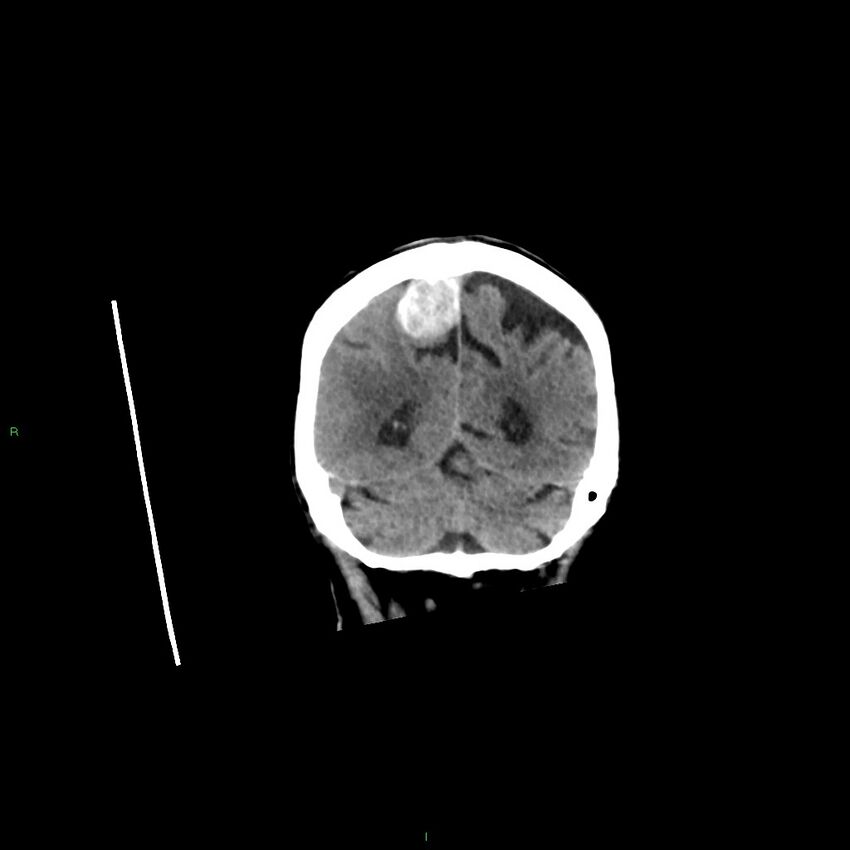 Basal ganglia hemorrhage (Radiopaedia 58350-65473 Coronal non-contrast 17).jpg