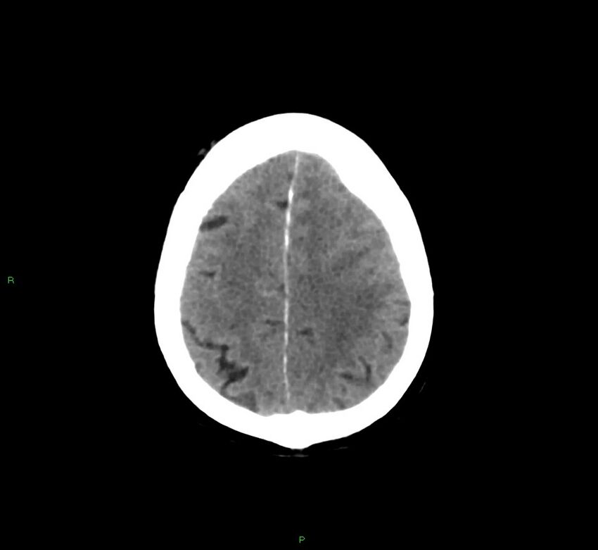 Basal ganglia hemorrhage (Radiopaedia 58775-66008 Axial non-contrast 16).jpg