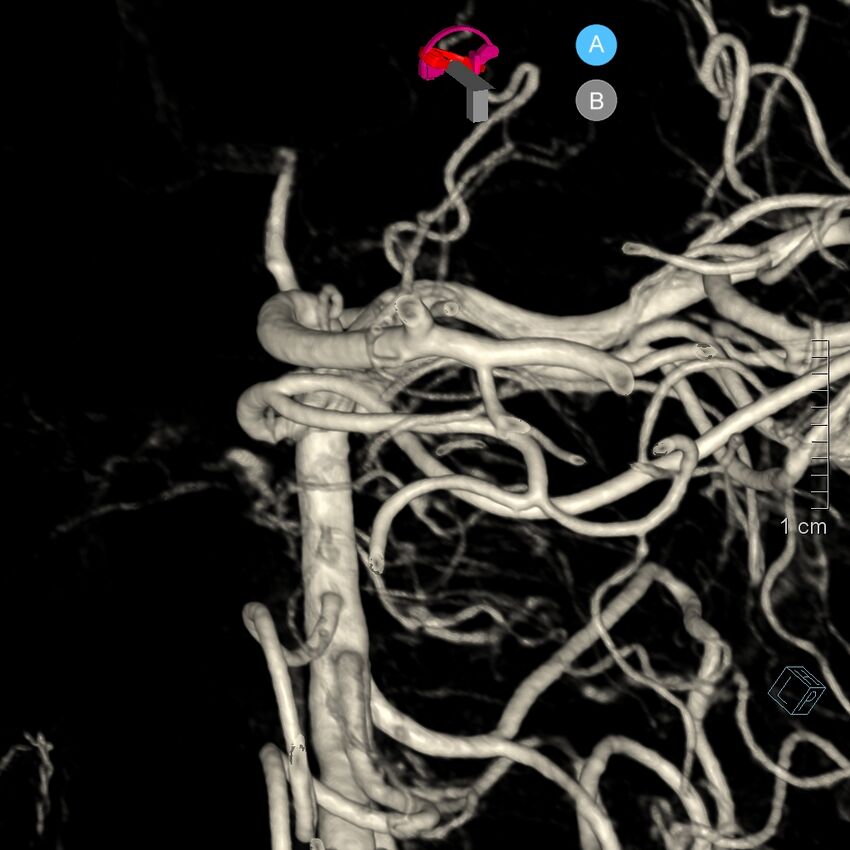 Basilar artery perforator aneurysm (Radiopaedia 82455-97734 3D view left VA 174).jpg