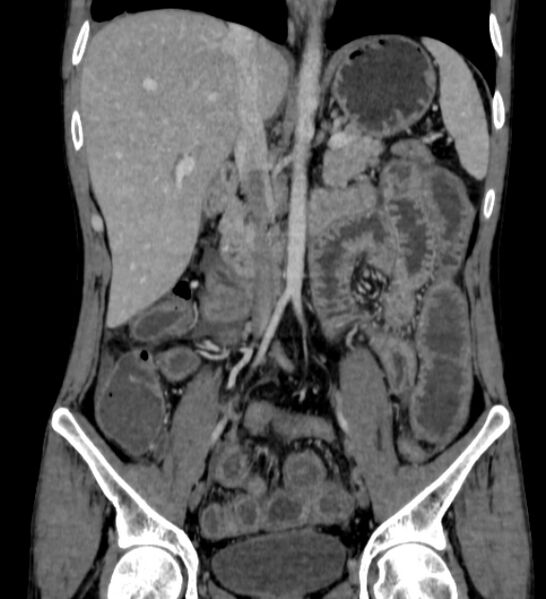 File:Behçet's disease- abdominal vasculitis (Radiopaedia 55955-62570 B 28).jpg