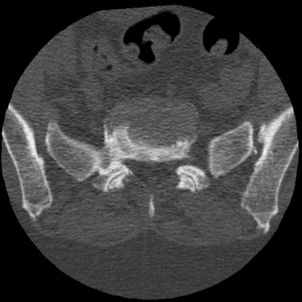 File:Bertolotti syndrome (Radiopaedia 24864-25128 Axial bone window 32).jpg