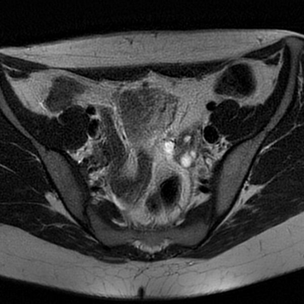 File:Bicornuate uterus (Radiopaedia 72135-82643 Axial T2 6).jpg