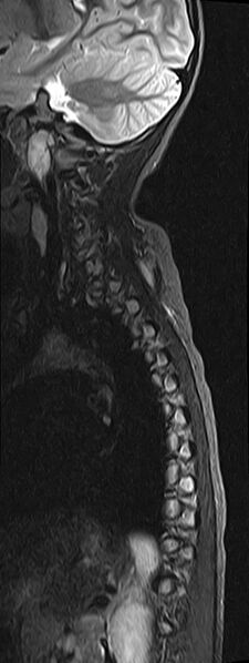 File:Bilateral Sprengel deformity with Klippel-Feil syndrome (Radiopaedia 66395-75650 Sagittal STIR 11).jpg