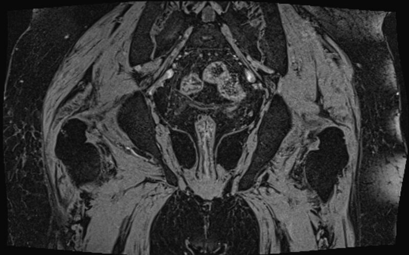 File:Bilateral avascular necrosis of femoral head (Radiopaedia 77116-89078 Coronal T2 we 2).jpg