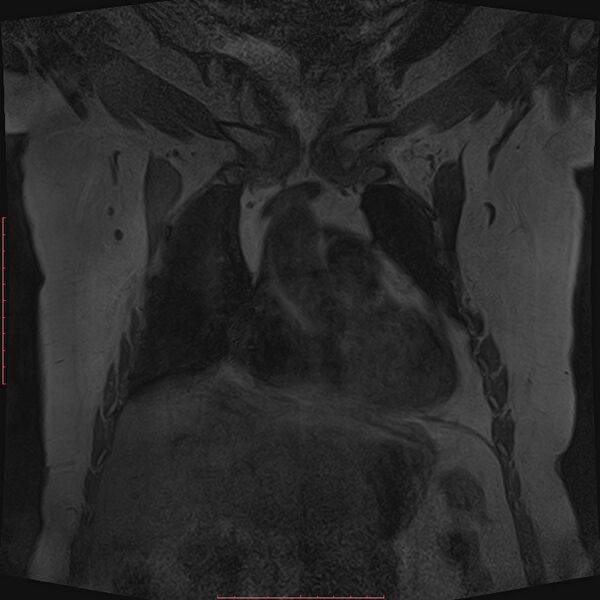File:Bilateral breast implant rupture (Radiopaedia 24761-25027 G 2).jpg