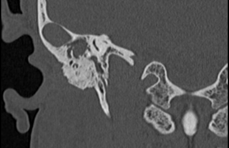 File:Bilateral cholesteatoma (Radiopaedia 54898-61172 Coronal bone window 58).jpg