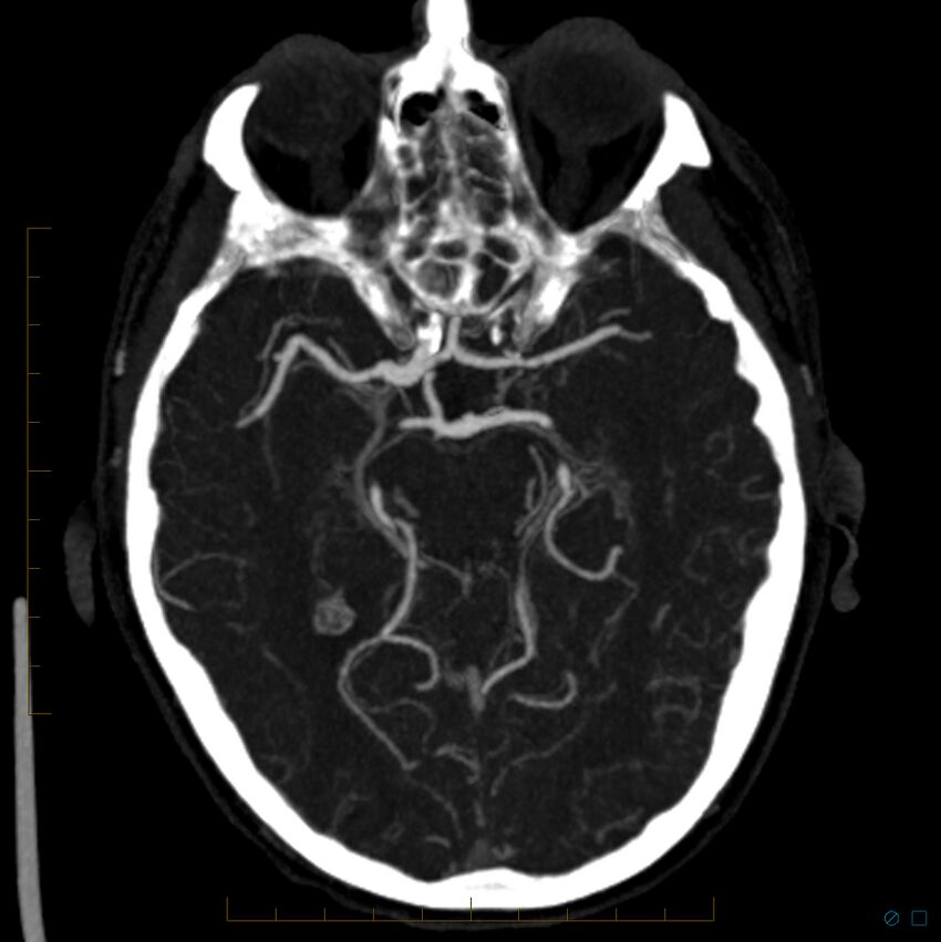 Bilateral chronic common carotid occlusion (Radiopaedia 50849-56362 D 18).jpg