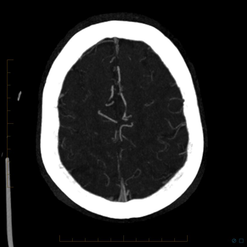 Bilateral chronic common carotid occlusion (Radiopaedia 50849-56362 D 7).jpg