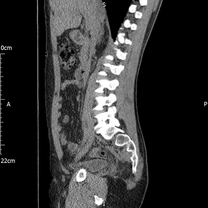 Bilateral medullary nephrocalcinosis with ureteric calculi (Radiopaedia 71269-81569 C 70).jpg