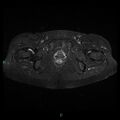 Bilateral ovarian fibroma (Radiopaedia 44568-48293 Axial STIR 25).jpg