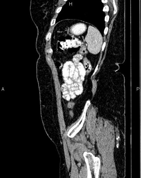 File:Bilateral ovarian serous cystadenocarcinoma (Radiopaedia 86062-101989 E 76).jpg