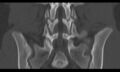 Bilateral pars defect (Radiopaedia 26691-26846 Coronal bone window 30).jpg