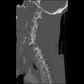 Bilateral perched facets with cord injury (Radiopaedia 45587-49713 Sagittal bone window 36).jpg