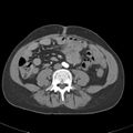 Biliary necrosis - liver transplant (Radiopaedia 21876-21845 A 40).jpg