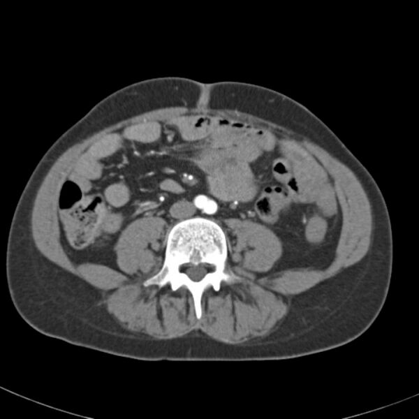 File:Biliary necrosis - liver transplant (Radiopaedia 21876-21845 A 40).jpg