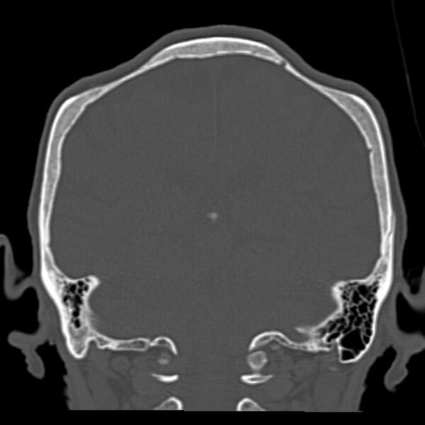 File:Biparietal osteodystrophy (Radiopaedia 46109-50463 Coronal bone window 70).jpg