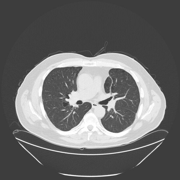 File:Birt-Hogg-Dubé syndrome (Radiopaedia 52578-58491 Axial lung window 29).jpg
