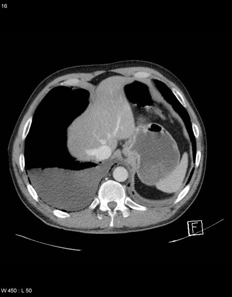 File:Boerhaave syndrome with tension pneumothorax (Radiopaedia 56794-63603 A 8).jpg