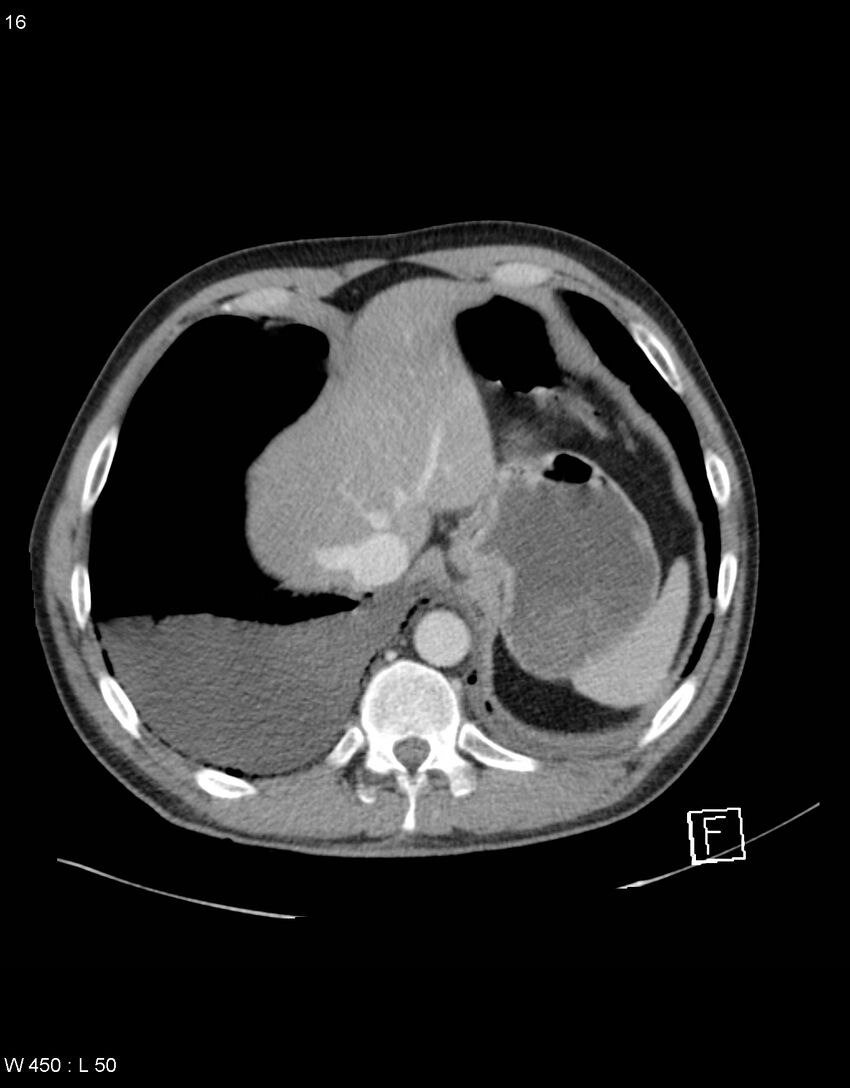 Boerhaave syndrome with tension pneumothorax (Radiopaedia 56794-63603 A 8).jpg