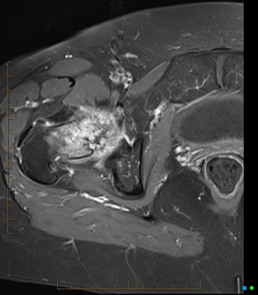 File:Bone metastasis - breast cancer (Radiopaedia 16667-16374 Axial T1 C+ fat sat 9).jpg