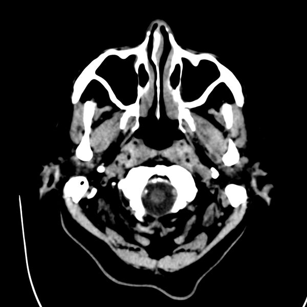 File:Brain Pantopaque remnants (Radiopaedia 78403-91048 Axial non-contrast 15).jpg