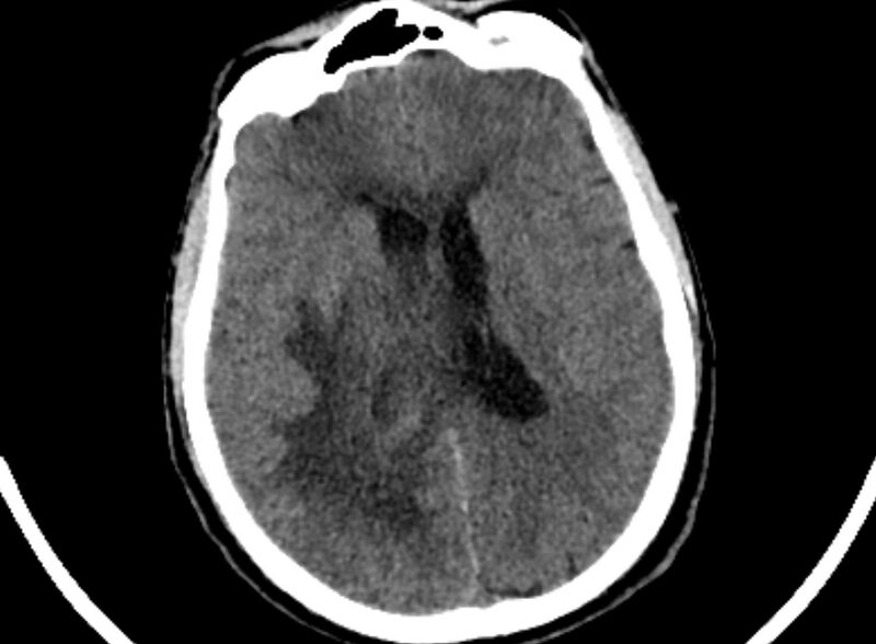 File:Brain abscess complicated by intraventricular rupture and ventriculitis (Radiopaedia 82434-96575 Axial non-contrast 56).jpg