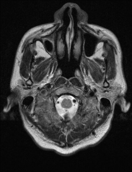 File:Brain abscess with ventriculitis (Radiopaedia 85703-101495 Axial T2 1).jpg