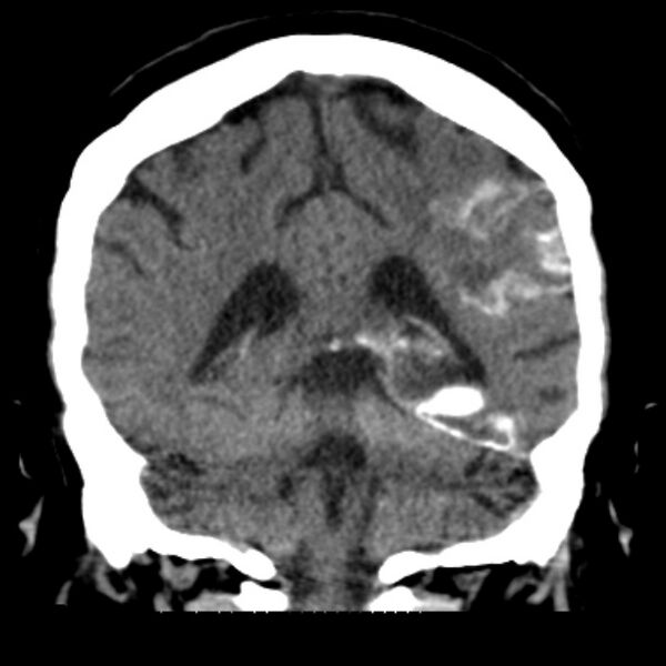 File:Brain cortical laminar necrosis (Radiopaedia 25822-25971 C 37).jpg