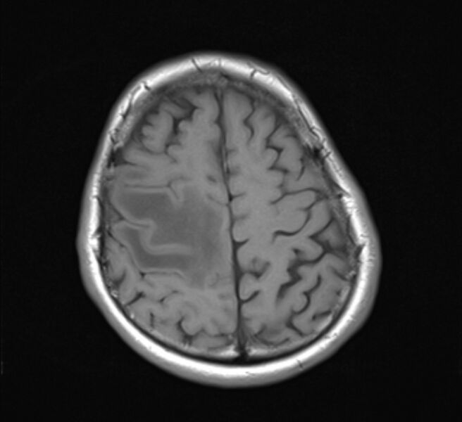 File:Brain metastases - lung cancer primary (Radiopaedia 75060-86115 Axial T1 20).jpg