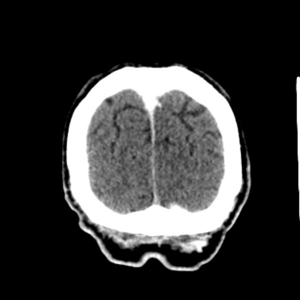 File:Brain metastases from lung cancer (Radiopaedia 27849-28092 Coronal C+ delayed 63).jpg