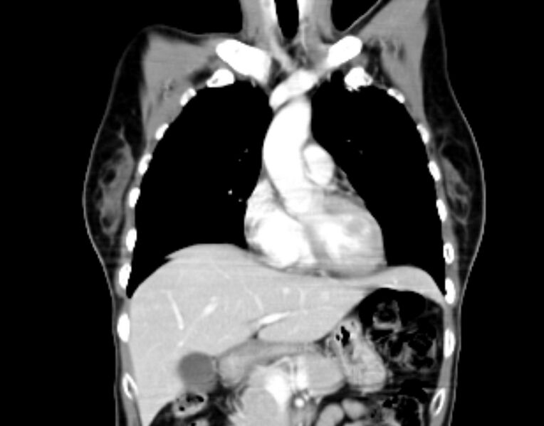 File:Brain metastasis as initial presentation of non-small cell lung cancer (Radiopaedia 65122-74127 C 10).jpg