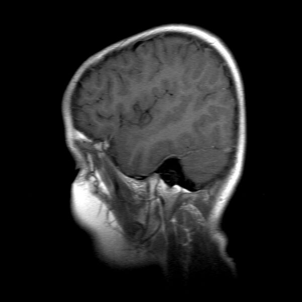 File:Brainstem ganglioglioma (Radiopaedia 10763-11224 Sagittal T1 C+ 4).jpg