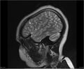 Brainstem glioma (Radiopaedia 21819-21775 Sagittal T2 1).jpg