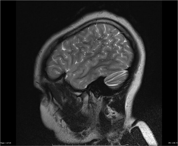 File:Brainstem glioma (Radiopaedia 21819-21775 Sagittal T2 1).jpg