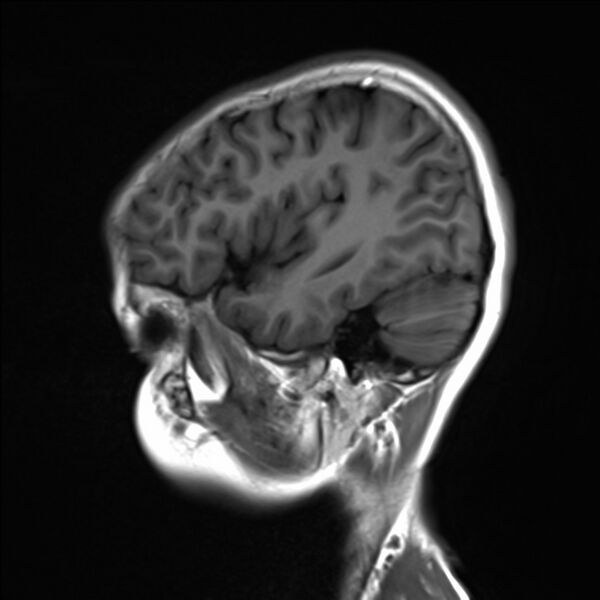 File:Brainstem glioma (Radiopaedia 70548-80674 Sagittal T1 20).jpg