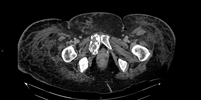 File:Breast cancer pelvic bony metastases (Radiopaedia 84470-99824 Axial bone window 70).jpg