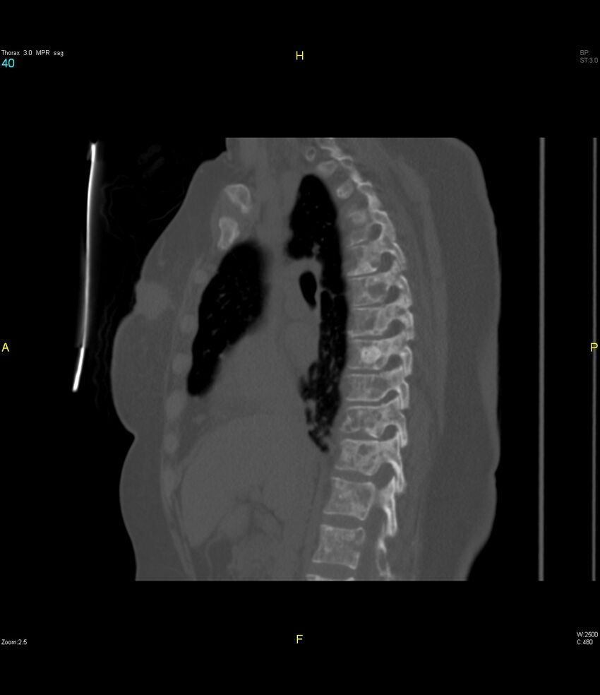 Breast primary with lung and bone metastases (Radiopaedia 40620-43228 Sagittal bone window 40).jpg