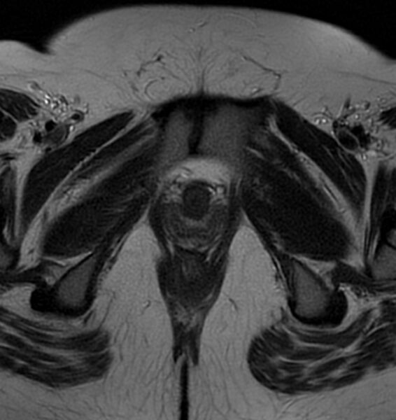 File:Broad ligament leiomyoma (Radiopaedia 81634-95516 Axial T2 26).jpg