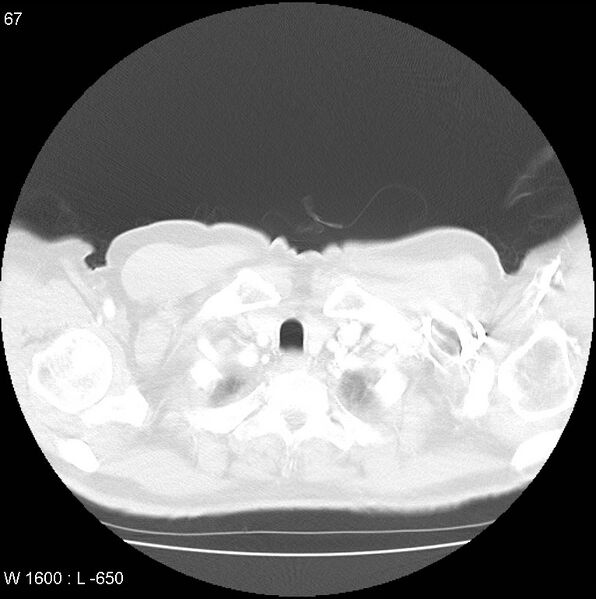 File:Bronchial carcinoid tumor with right lower lobe collapse (Radiopaedia 29060-29422 B 5).jpg