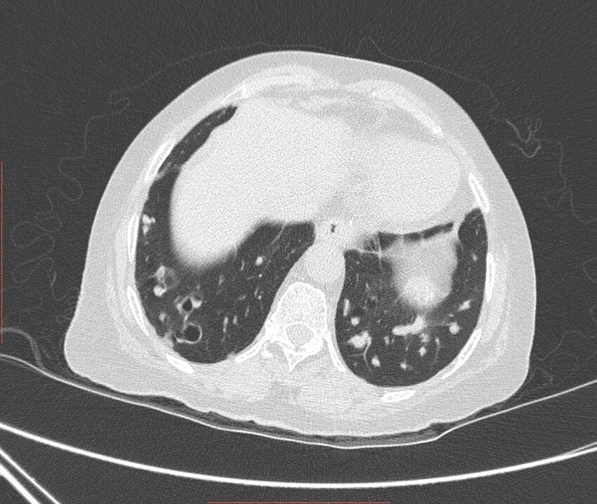 Bronchiectasis (Radiopaedia 72693-83293 Axial lung window 113).jpg
