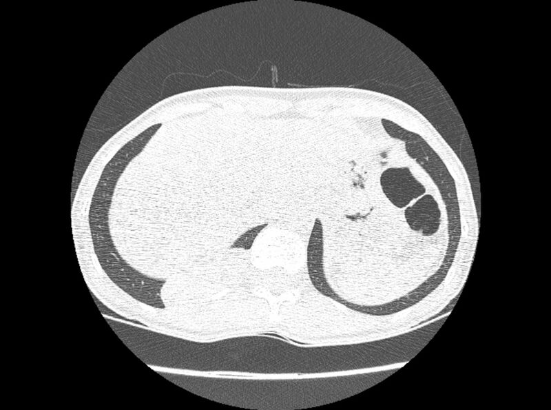 File:Bronchogenic cyst (Radiopaedia 80273-93615 Axial lung window 38).jpg