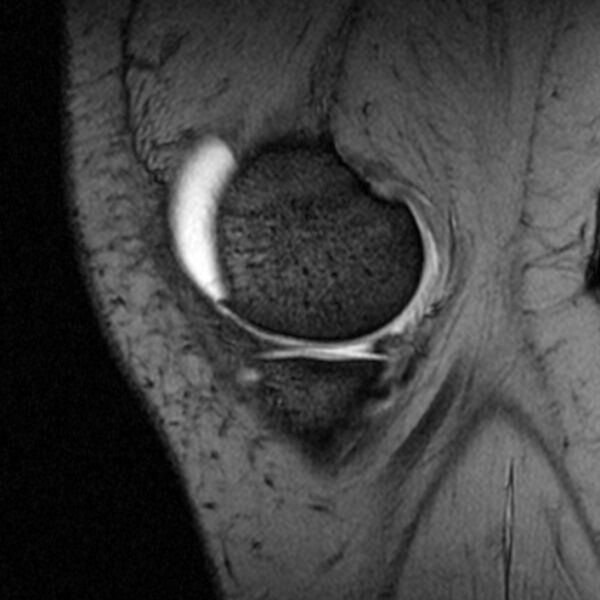 File:Bucket handle tear - medial meniscus (Radiopaedia 79028-91942 D 21).jpg