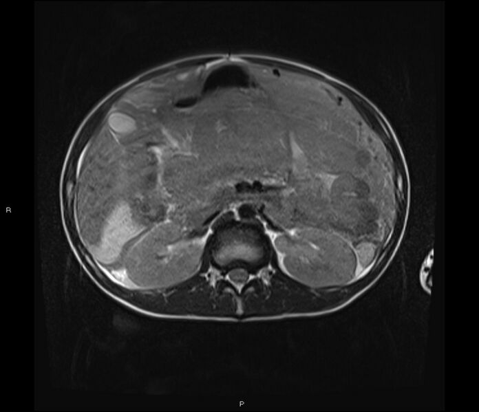File:Burkitt lymphoma (bowel) (Radiopaedia 68839-78557 Axial T2 24).jpg