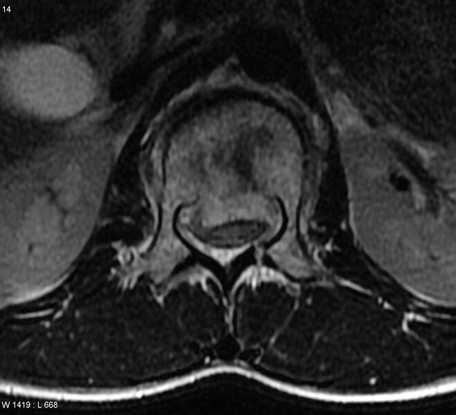 File:Burst lumbar fracture (Radiopaedia 4635-6718 Axial T2 1).jpg