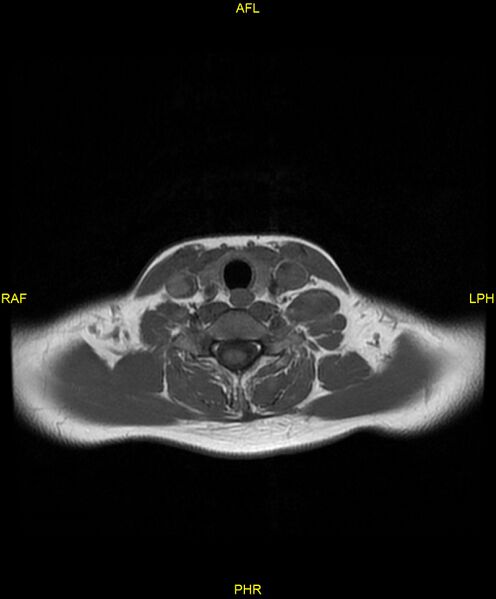 File:C5 nerve sheath tumor (Radiopaedia 85777-101596 Axial T1 20).jpg